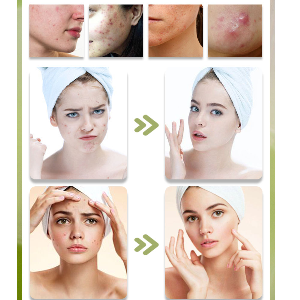KStims Natural Acne Treatment  – Tea Tree Spot Treatment recenzja i cena